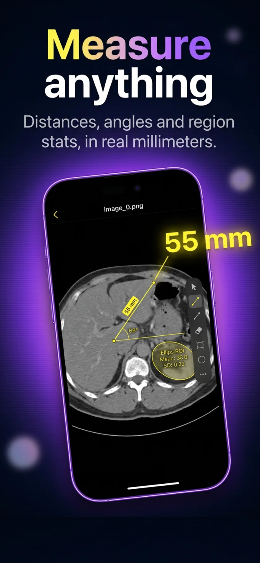 Slicora measuring a CT scan: a 55 mm distance, an angle and a region-of-interest ellipse